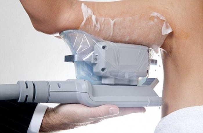 fat freezing arms Loughborough