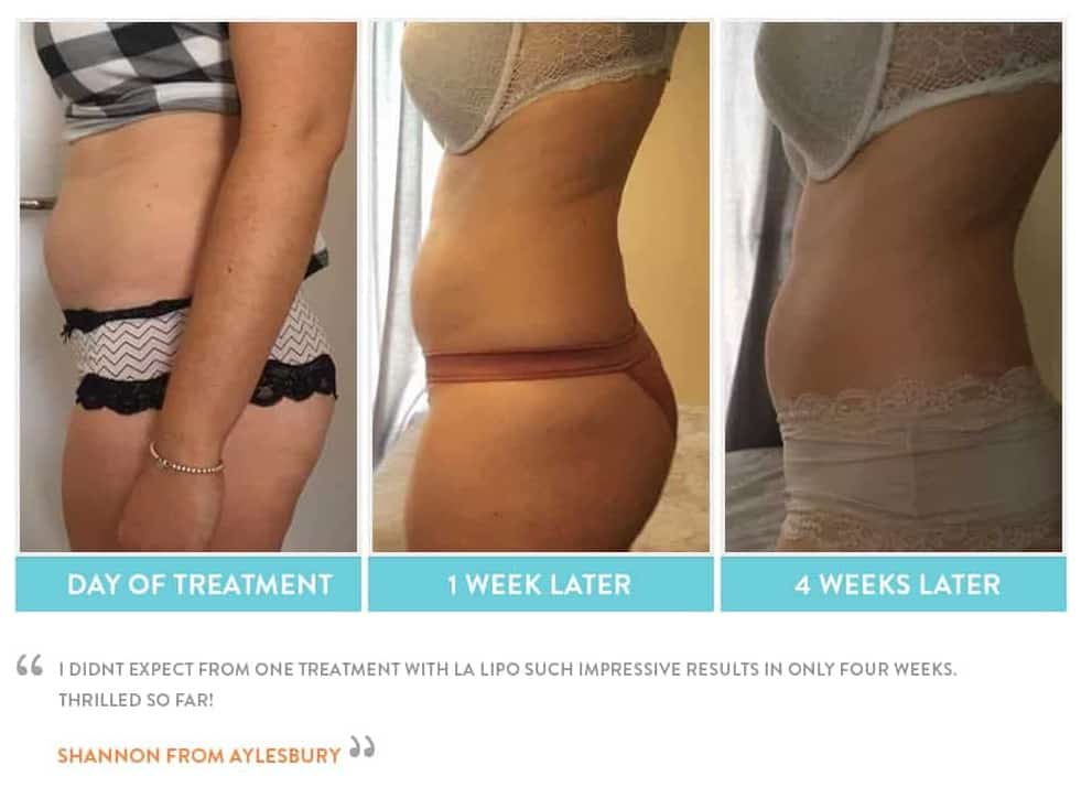 before, Cryolipolysis Loughborough