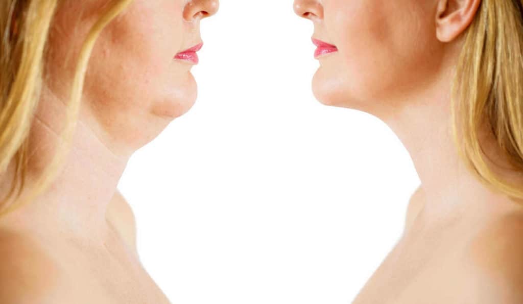 Double Chin treatment Loughborough before and after results