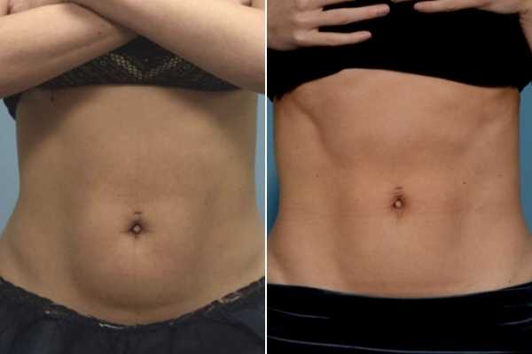 body sculpting FAQs Loughborough