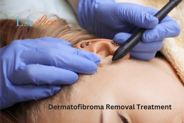 Dermatofibroma Removal Treatment Loughborough
