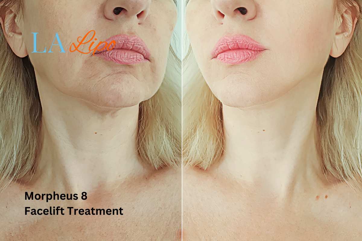 Turn back time with Morpheus8 Treatment Loughborough