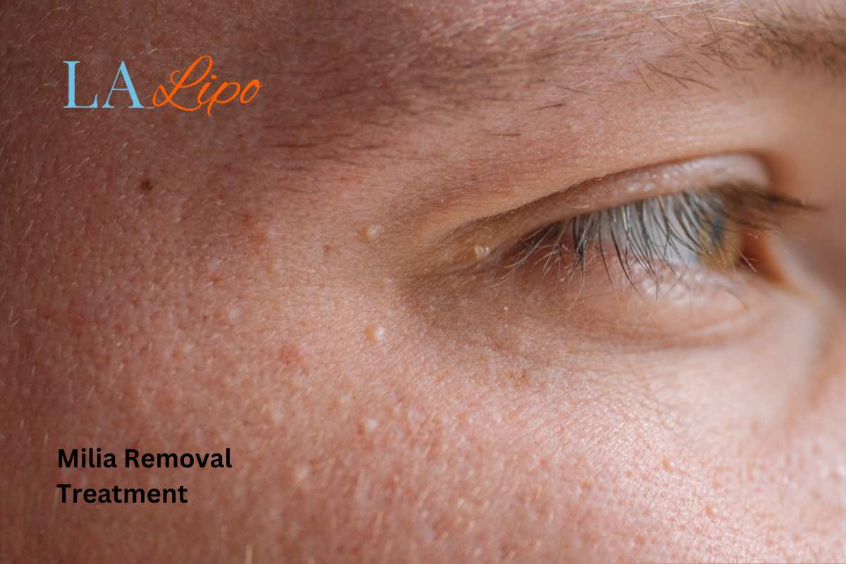 Cryopen Milia Removal: Is It the Easiest and Safest Option Loughborough?