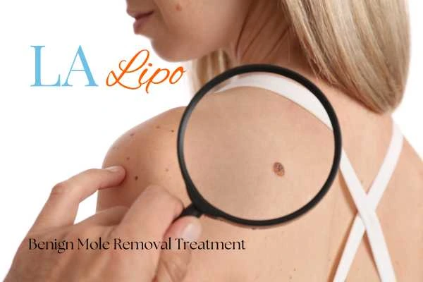 Woman having her inspection of blemish before mole removal Loughborough