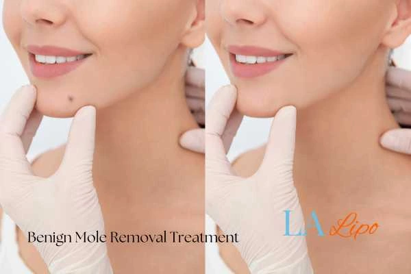 Before and after mole removal Loughborough treatment