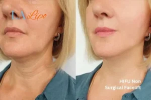 hi-fu for wrinkles Loughborough before and after results