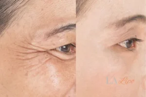 Before and after results of woman - HI-fu wrinkles reduction treatment Loughborough
