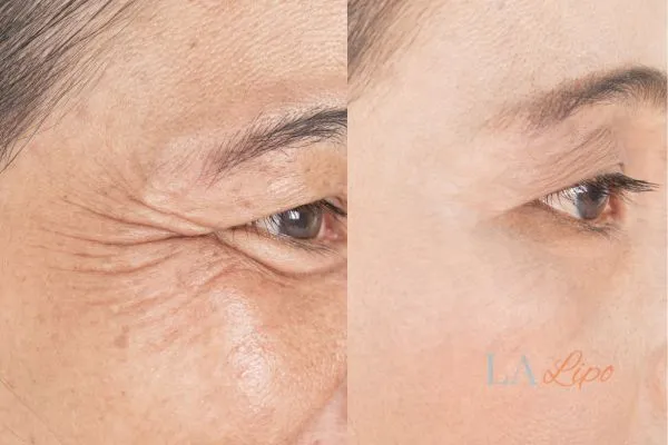 Before and after results of woman - HI-fu wrinkles reduction treatment Loughborough
