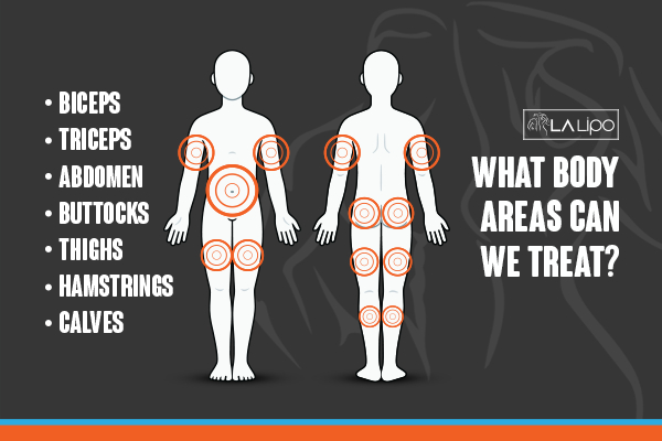 Graphic to show areas you can have LA-EMS Body Sculpting Loughborough treatment.