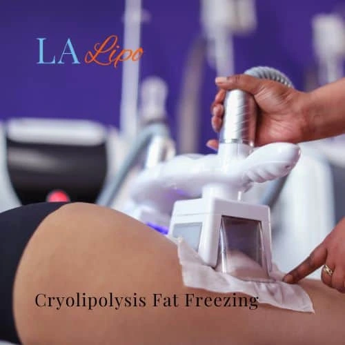 fat freezing - Cryolipolysis Loughborough