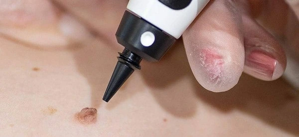 skin tag removal using cryopen Loughborough