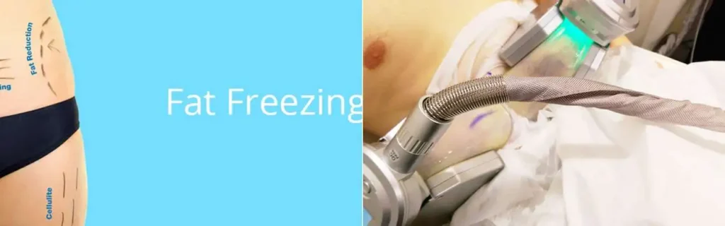 multi areas of a persons body having coolsculpting Loughborough treatment