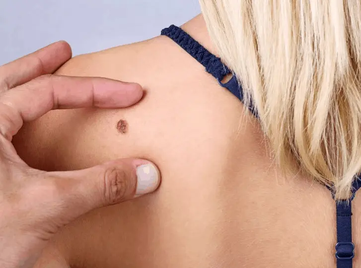 woman having mole removal Loughborough consultation before treatment.