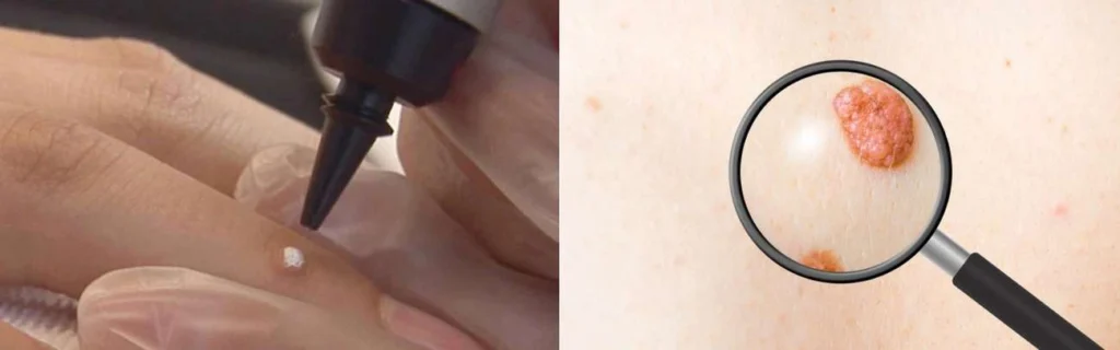 Person getting moles removed with cryopen Loughborough