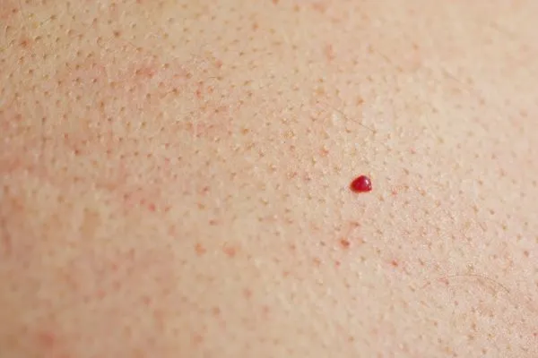 close up of a cherry angioma Loughborough