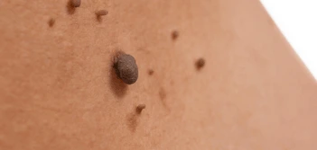 image of a skin tag Loughborough
