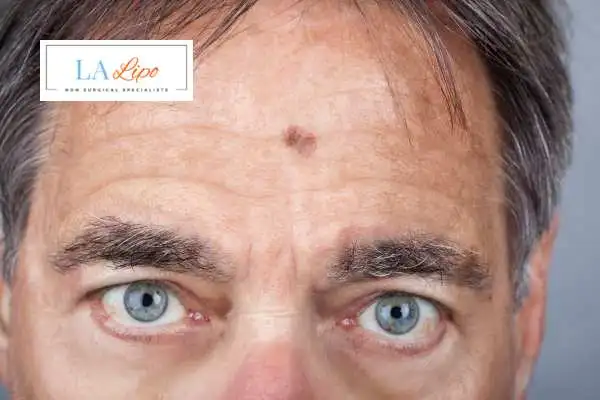 Solar Lentigo Removal Loughborough image of man with mark on his forehead
