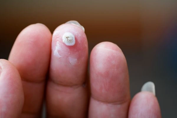 wart on person finger - cryotherapy to treat from LA LIPO Loughborough