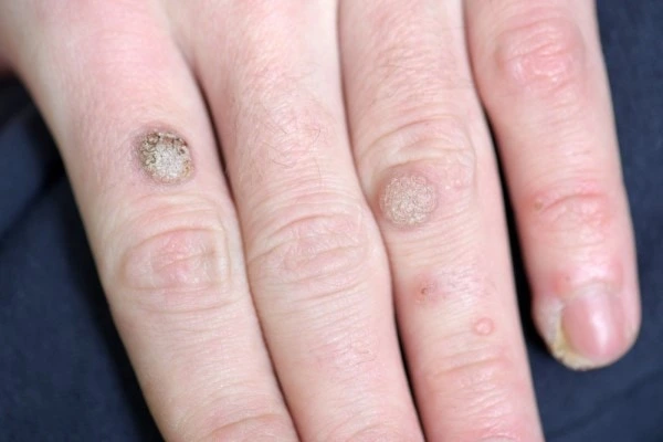 photo of warts on person hand - see wart removal Loughborough from LA LIPO