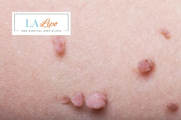 Does cryopen skin tag removal Loughborough hurt? Find out now call our team today!