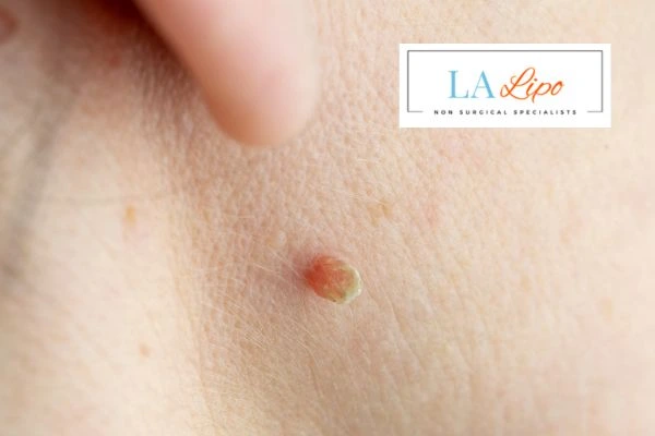Book skin tag removal Loughborough today speak to our team now!