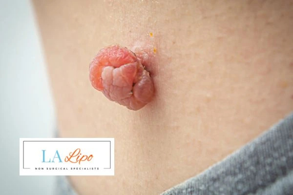 Interested in skin tag removal Loughborough? Concerned about the pain? Find out more today!