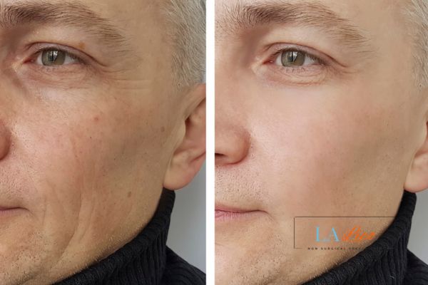 See the amazing results of Morpheus8 Treatment Loughborough!