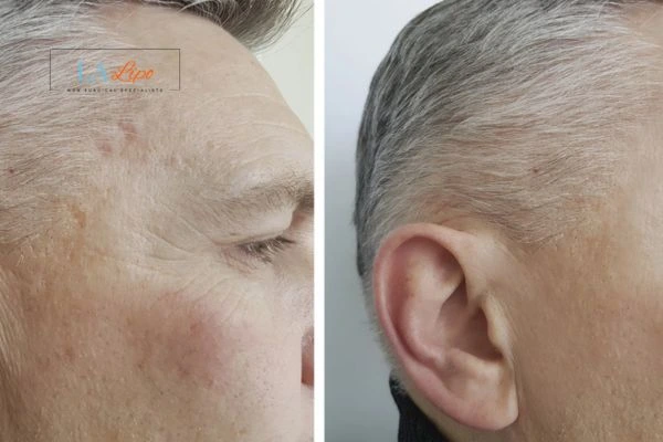 Mens Before & After Morpheus 8 Results Loughborough