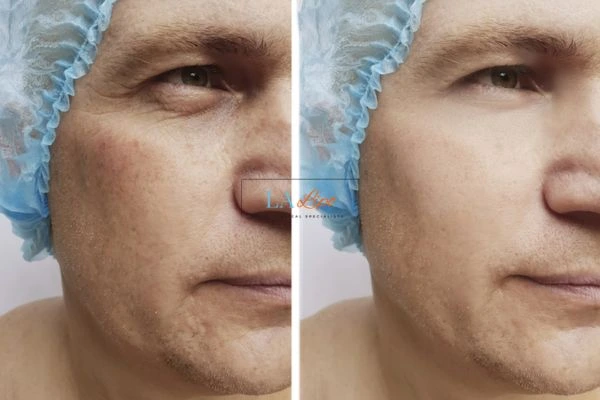 Before and after Morpheus 8 Results Loughborough