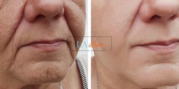 Older lady deeper wrinkle reduction - LA LIPO Morpheus 8 Results Loughborough