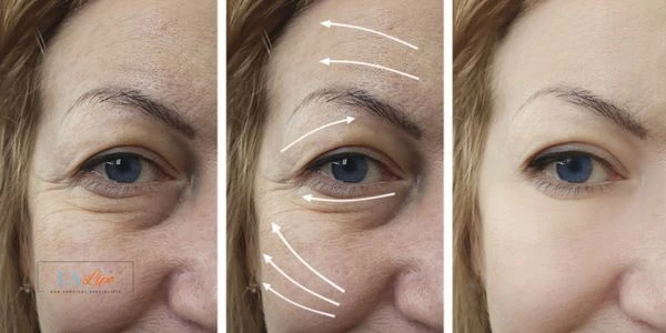 Amazing eye lift Morpheus 8 results Loughborough
