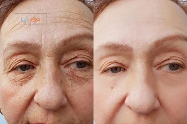 The powerful benefits of Morpheus8 Treatment Loughborough - Call Our team today!