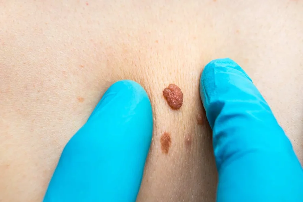 LA LIPO Cryopen Lesion Removal Prices Loughborough
