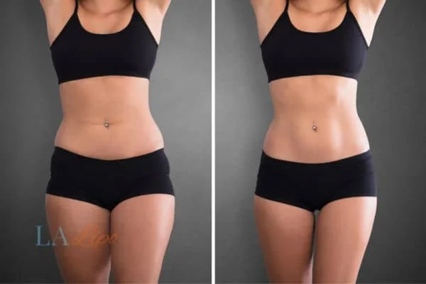 before and after results of non-surgical treatment to help a woman's body image and mental health Loughborough