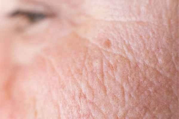 close up picture of a woman's face showing an age spot Loughborough