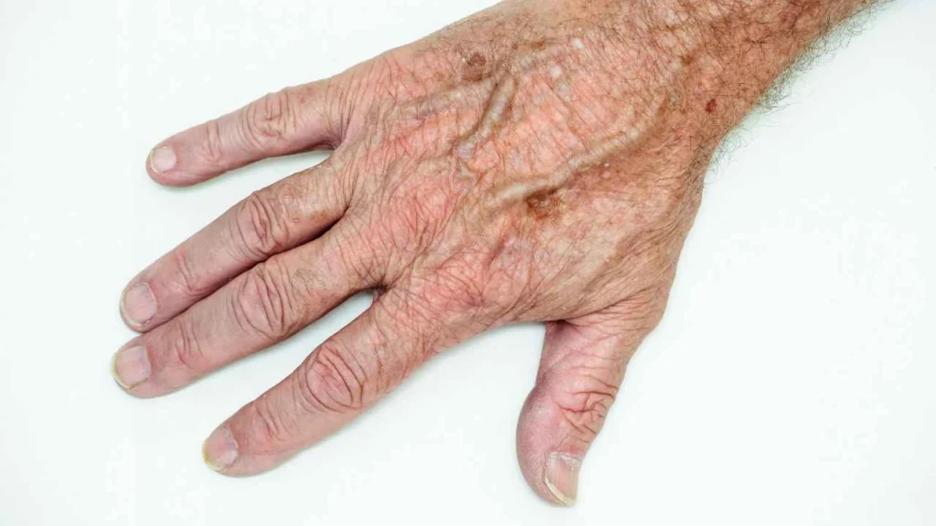 Male hand showing age spot Loughborough