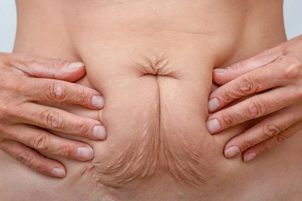 Image of a woman's stomach with loose skin - example of skin tightening Loughborough options