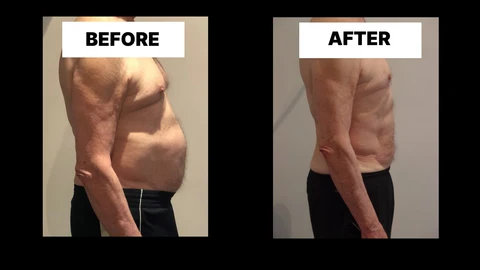 What Symptoms Can Diastasis Recti Cause in Men? Weak Core, Back Pain and Poor Posture Loughborough